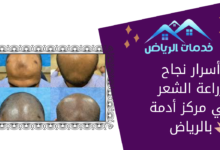 أسرار نجاح زراعة الشعر في مركز أدمة بالرياض