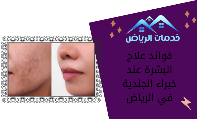 فوائد علاج البشرة عند خبراء الجلدية في الرياض