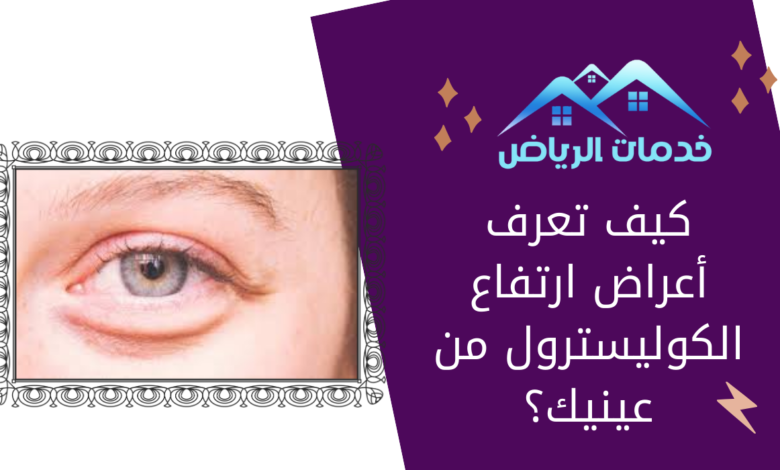 كيف تعرف أعراض ارتفاع الكوليسترول من عينيك؟