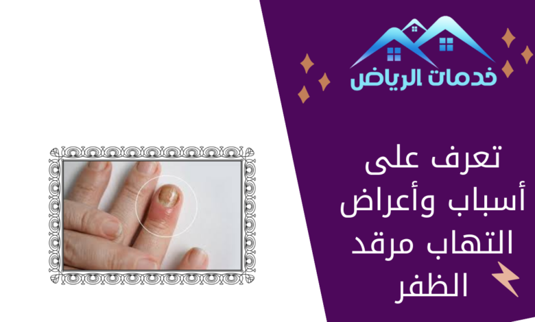 تعرف على أسباب وأعراض التهاب مرقد الظفر