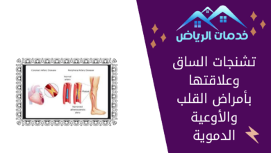 تشنجات الساق وعلاقتها بأمراض القلب والأوعية الدموية