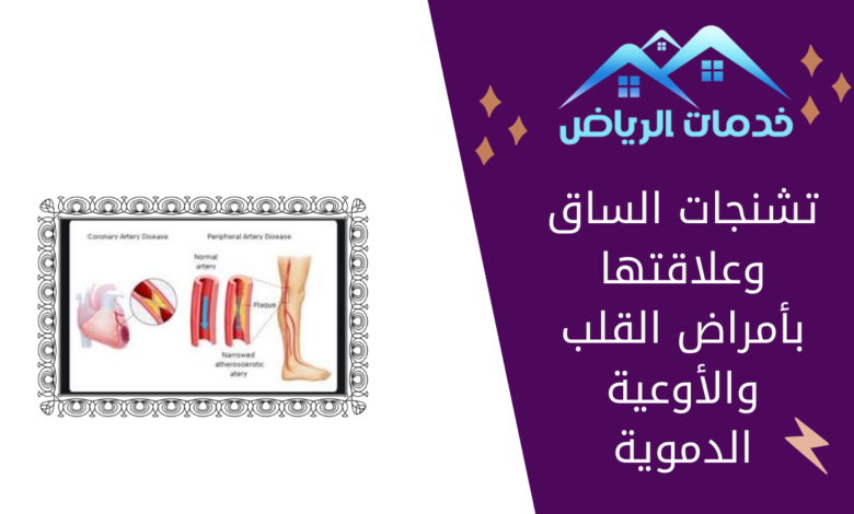 تشنجات الساق وعلاقتها بأمراض القلب والأوعية الدموية